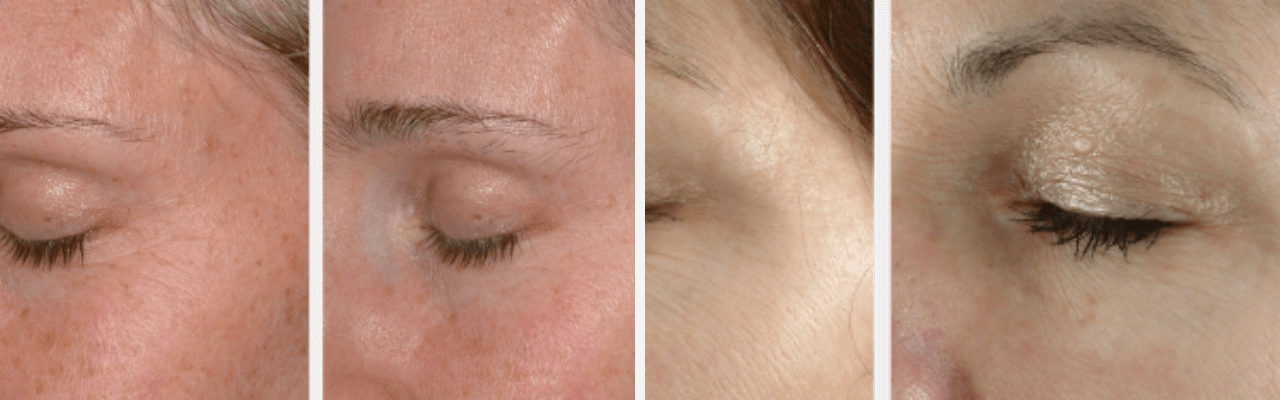 Exuviance Performance Peel Before and After Shots